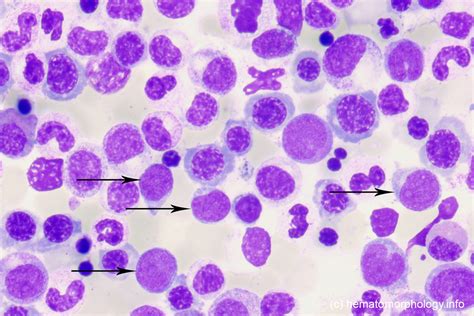 Mds With Excess Of Blasts Eb 1 Hematomorphology A Databank