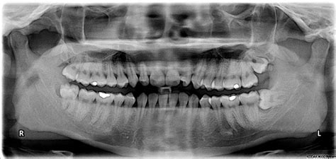 Impacted Wisdom Tooth Causes Diagnosis And Symptoms