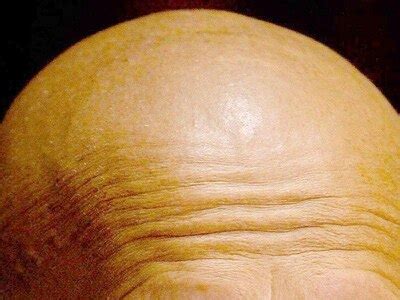 Scientists Discover Critical Breakthrough In Cure For Baldness