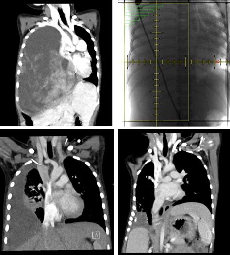 Contrast Enhance Chest Computed Tomography Scans A Before Treatment