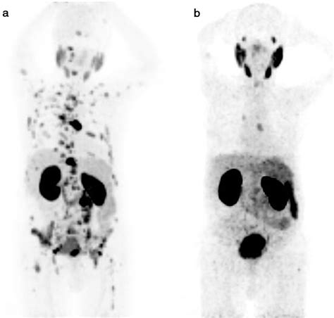 Assessment Of The Role Of Ga 68 PSMA I T PET CT In Response Evaluation