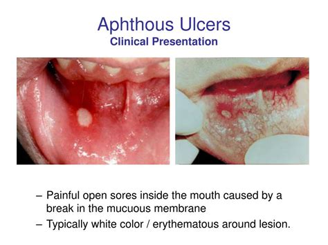 Ppt Oral Medicine Block Presentation Aphthous Ulcers Powerpoint Presentation Id