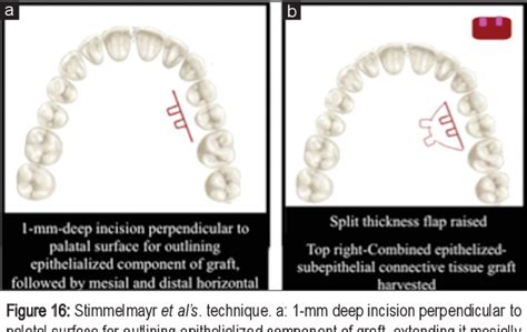 Year Journey Of Palatal Connective Tissue Graft Harvest A Narrative