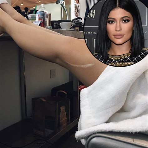 Kylie Jenner Flaunts Huge Leg Scar Is Kendall To Blame For It E Online