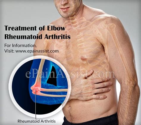 Elbow Rheumatoid Arthritiscausessymptomstreatmentsurgeryphysical
