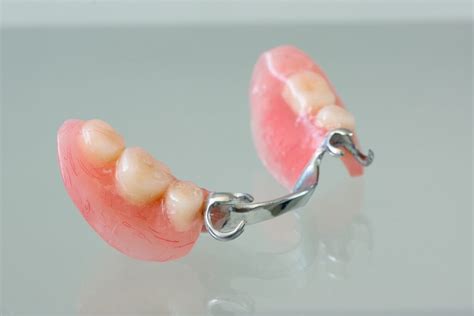 what are flexible partial dentures sarasota dentistry
