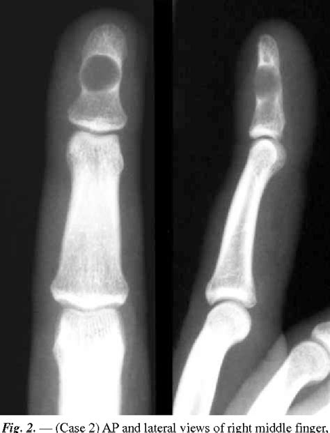 Figure 2 From Phalangeal Intraosseous Epidermoid Cyst Semantic Scholar