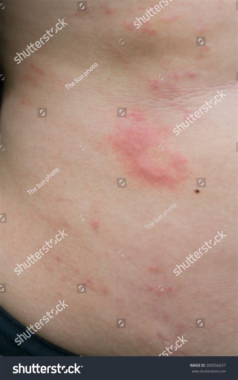 Woman Urticaria On Belly Stock Photo 300556637 Shutterstock
