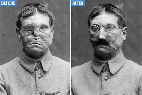 Sculptor Made Masks For Wounded Wwi Soldiers With Disfigured Face