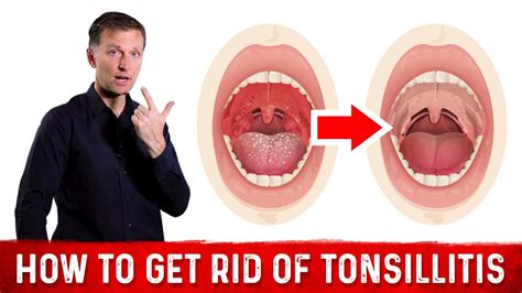How To Get Rid Of Painful Swollen Tonsils Tonsillitis Drberg