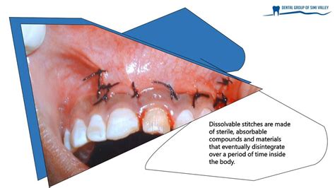 Ppt What To Know About Dissolvable Stitches After Wisdom Teeth