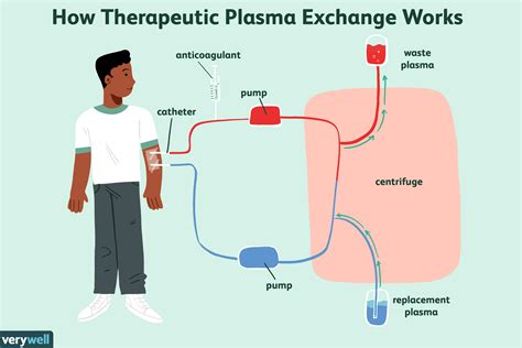 ¿qué Es El Intercambio De Plasma Terapéutico Tpe Medicina Básica