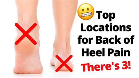 Details 136 Foot Pain Base Of Heel Best Esthdonghoadian