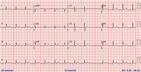 Atrial Flutter With Exercise Induced Atrioventricu Vrogue Co