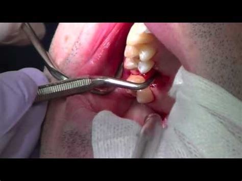 Your teeth will be instantly whiter. Physics Forceps Upper Molar Tooth Extraction, Cytoplast Barrier & Grafting - YouTube