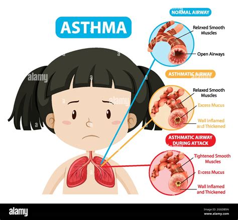 Asthma Diagram With Normal Airway And Asthmatic Airway Illustration
