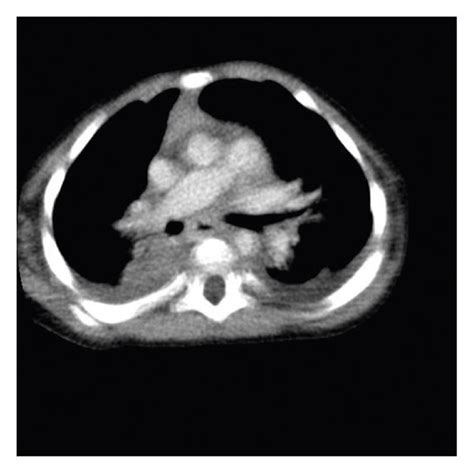 A Chest Radiograph After Birth B Chest Computed Tomography Ct