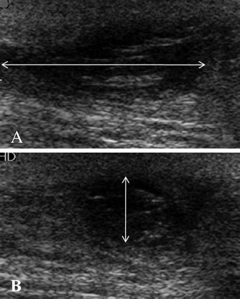 Figure 1 From Role Of Ultrasonography In Evaluation Of Pilonidal
