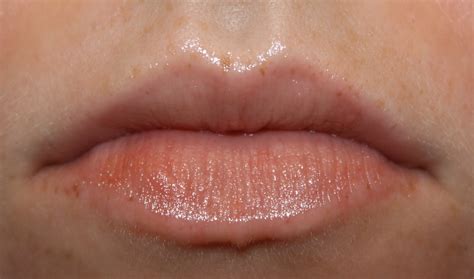 Allergic Reaction On Lips Eczema On The Lips Types Triggers Causes And Treatment That