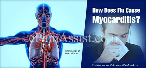Consult a doctor for medical advice. How Does Flu Cause Myocarditis?