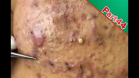 Part44 Amazing Giant Inflamed Blackheads Popping Awesome Top Skin Care