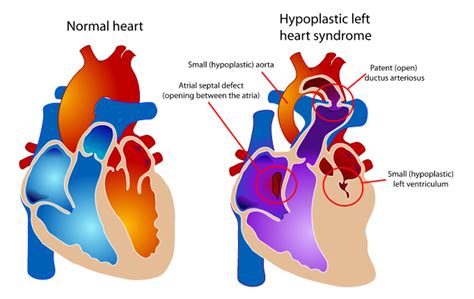 Hypoplastic Left Heart Syndrome Hlhs — Surgery And Survival Rate