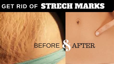 Get Rid Of Stretch Marks Fast Natural Home Remedies For Stretch Marks Guaranteed To Work √