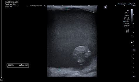 Hematocele Postoperative Testicular Ultrasound Image Radiopaedia Org