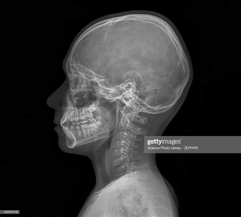 Normal Childs Head X Ray Of The Head Of A 13 Year Old X Ray