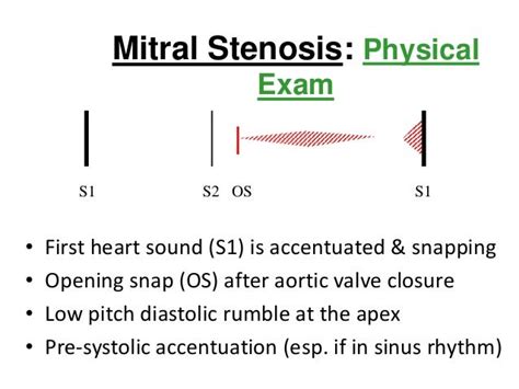 Mitral Stenosis