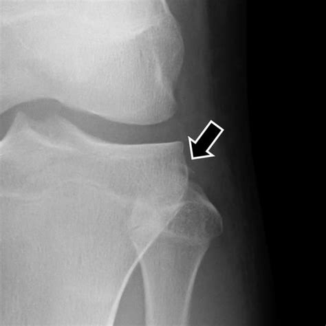 Arcuate Sign A Subtle But Important Avulsion Fracture Of The Proximal