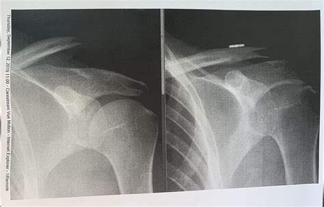 Grade 5 Ac Separation Ac Joint Separation Symptoms Steven Struhl Md