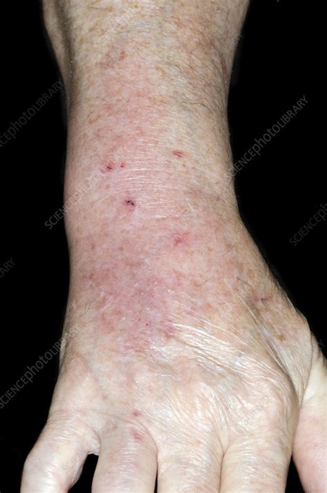 Infected Cat Bite On The Wrist Stock Image C0167241 Science