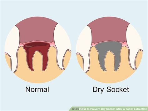 What Does Dry Socket Look Like After Wisdom Tooth Extraction