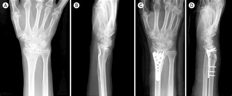 Figure 4 From Surgical Technique Of Corrective Osteotomy For Malunited