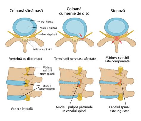 Condi Ie Gr Mad Masacru Operatie La Hernie De Disc Roti Exploda Indolen