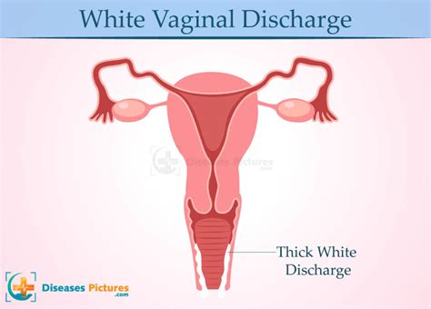 Vaginal Discharge White Brown Yellow Types Causes