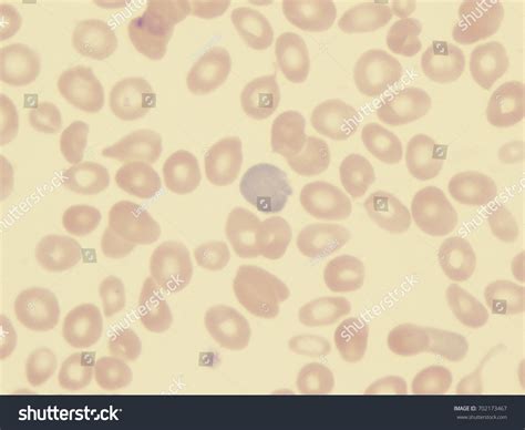 1 Reticulocytosis Images Stock Photos And Vectors Shutterstock