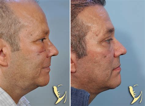 Lower Facelift Before After Scar Revision Robinson Fps
