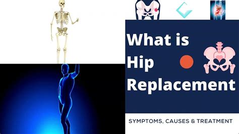Hip Replacement Surgery Symptoms Causes And Treatment Hip
