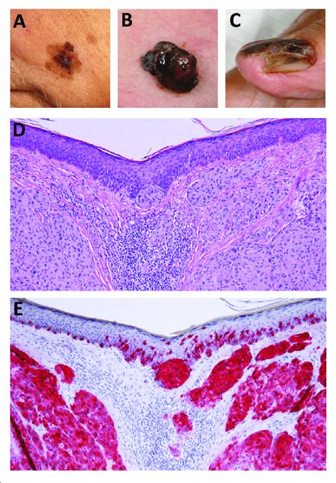 Melanoma Diagram