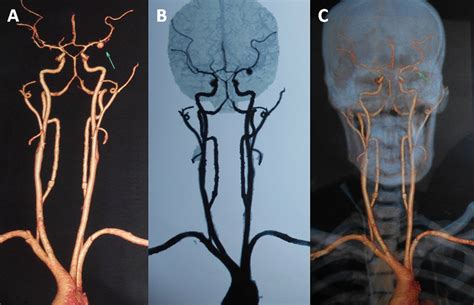 Complications of endocarditis, recent advances in infective endocarditis, steven w. Mycotic aneurysm: a rare and dreaded complication of ...
