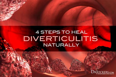 Diverticulitis Can Be An Extremely Unpleasant Condition Discover 4