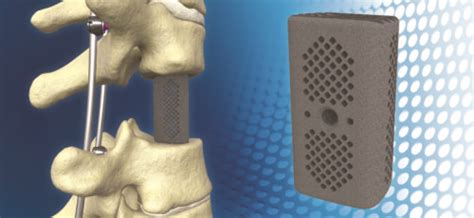 K2m First To Market With 3d Printed Corpectomy Cage System Following