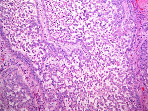 Squamous Cell Carcinoma Acantholytic Variant