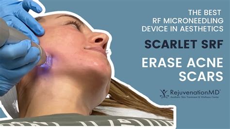 Eliminate Acne Scars With Scarlet Srf The Best Rf Microneedling