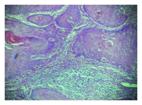 Preoperative Picture Of The Verrucous Squamous Cell Carcinoma