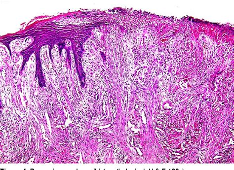 Persistent drainage from the base of the cord or chronic periumbilical inflammation unresponsive to the usual therapy for omphalitis. Figure 3 from PYOGENIC GRANULOMA Definition Pyogenic ...