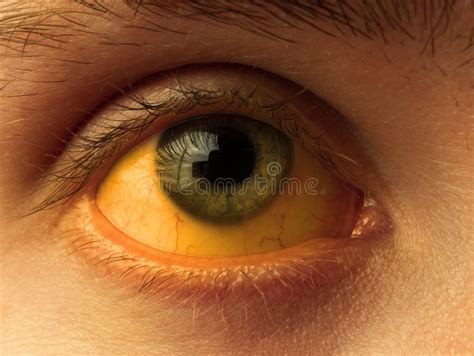 tinción amarilla de la esclera ocular en enfermedades de cirrosis hepática hepatitis foto de