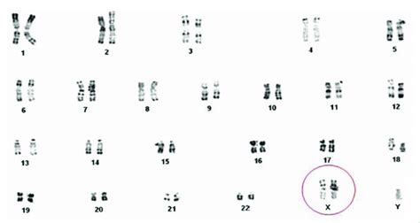 Karyotype Of A Patient With Klinefelter Syndrome 47 Xxy Download